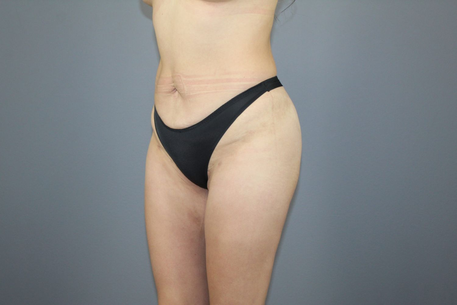 Liposuction Before & After