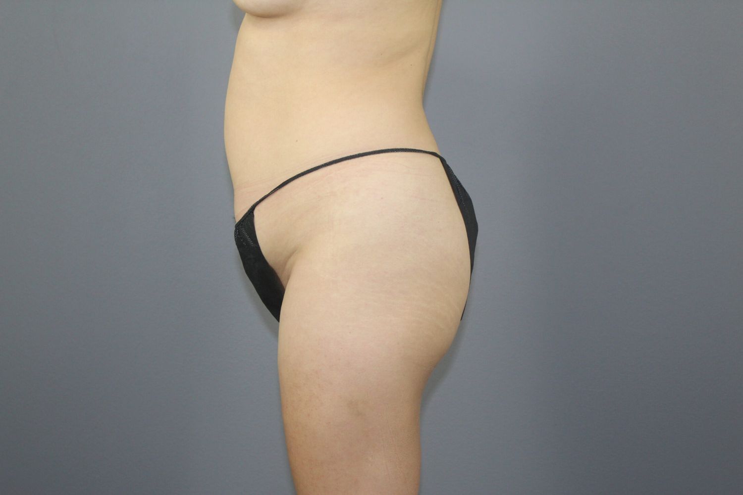 Liposuction Before & After