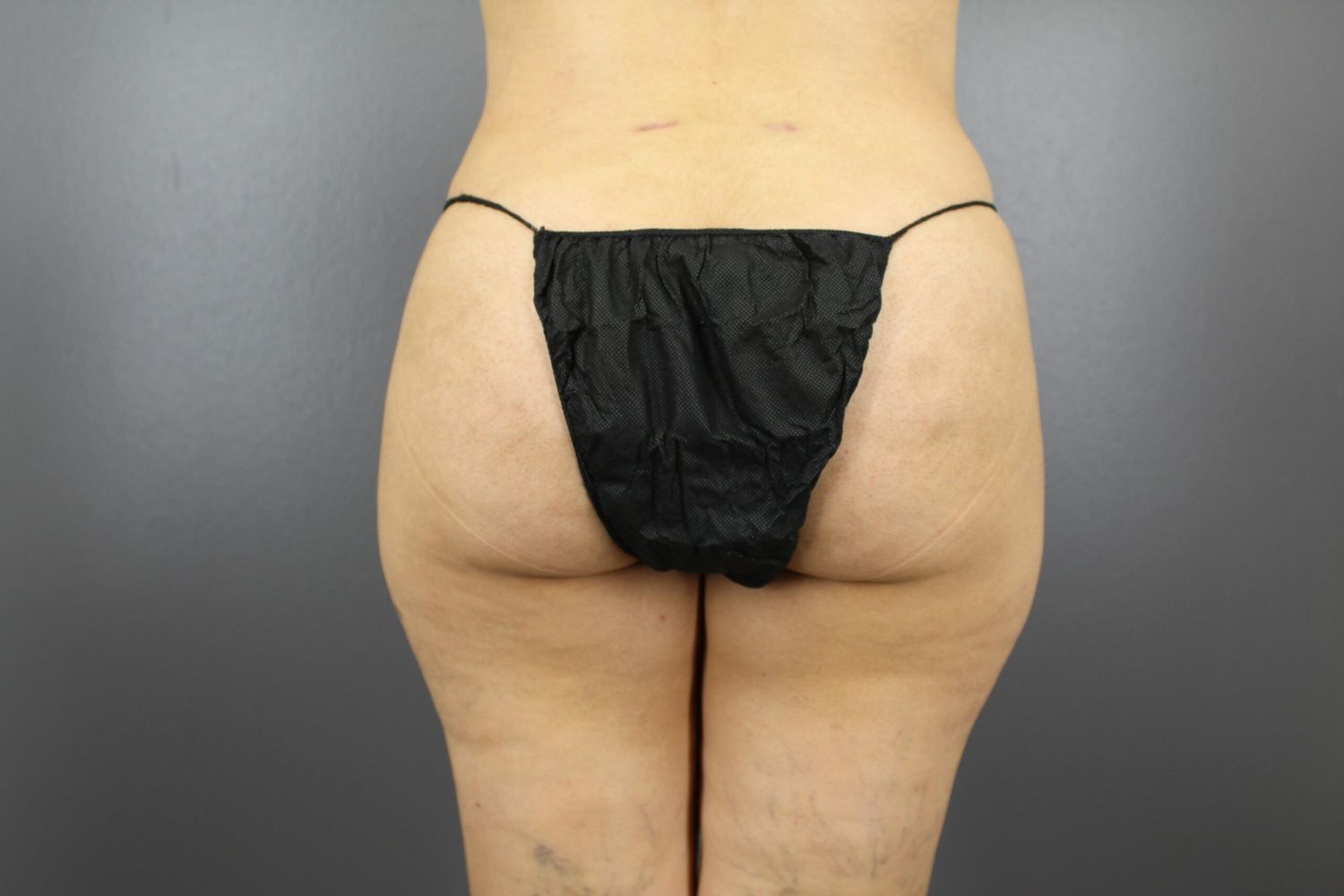 Liposuction Before & After