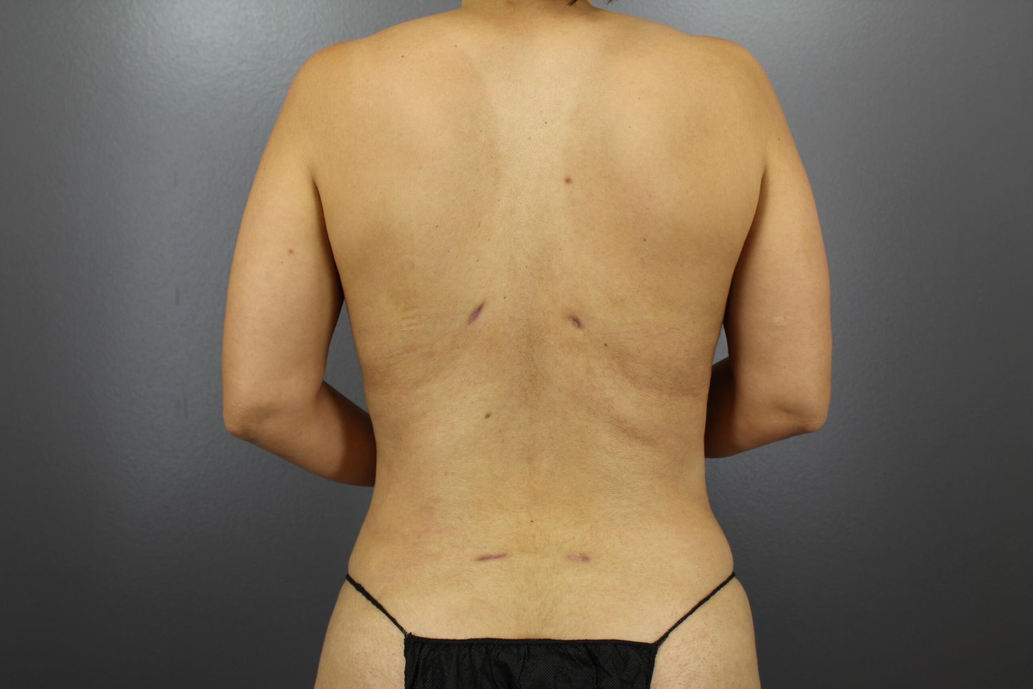 Liposuction Before & After