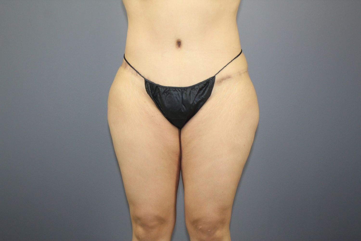 Liposuction Before & After