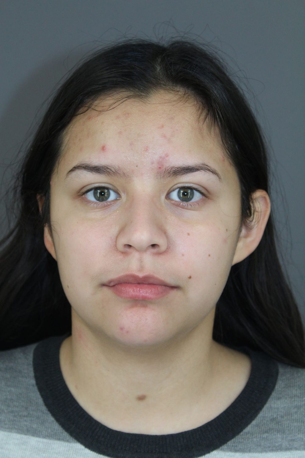 Liposuction Before & After