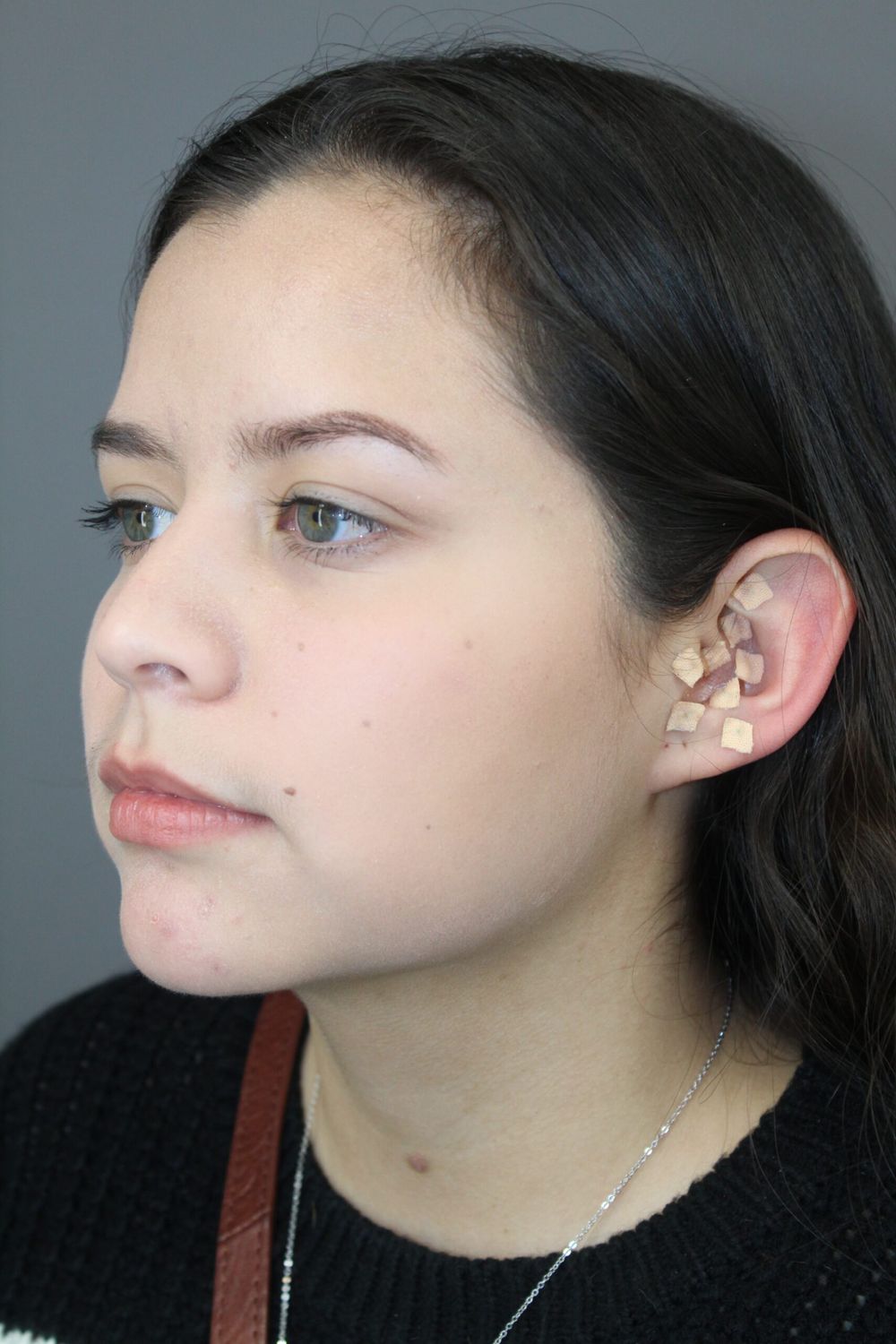 Liposuction Before & After