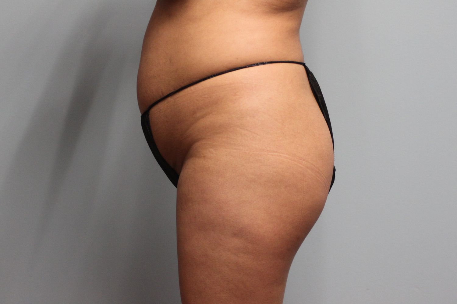 Liposuction Before & After