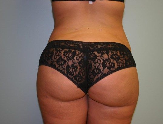 Liposuction Before & After