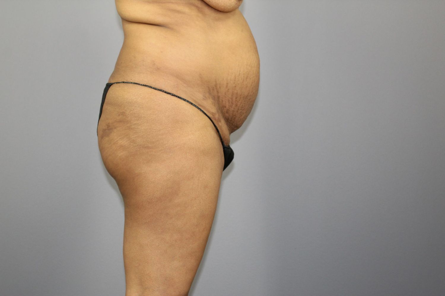 Liposuction Before & After