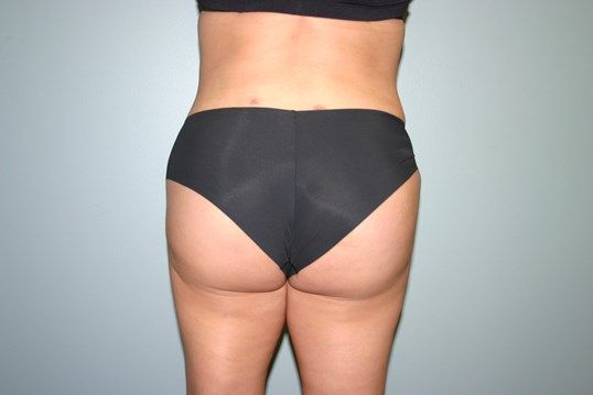 Liposuction Before & After