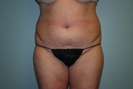 Liposuction Before & After