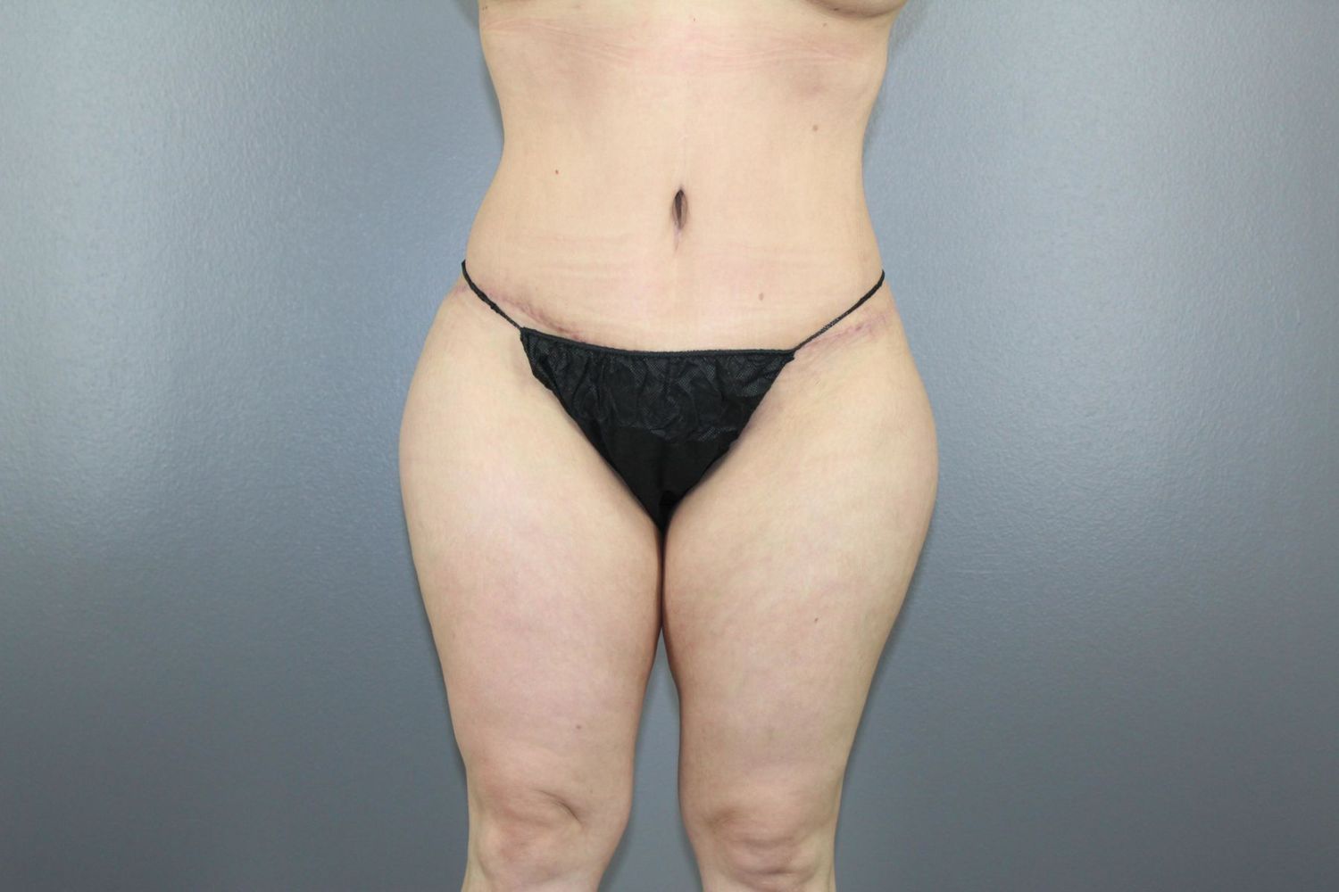 Liposuction Before & After
