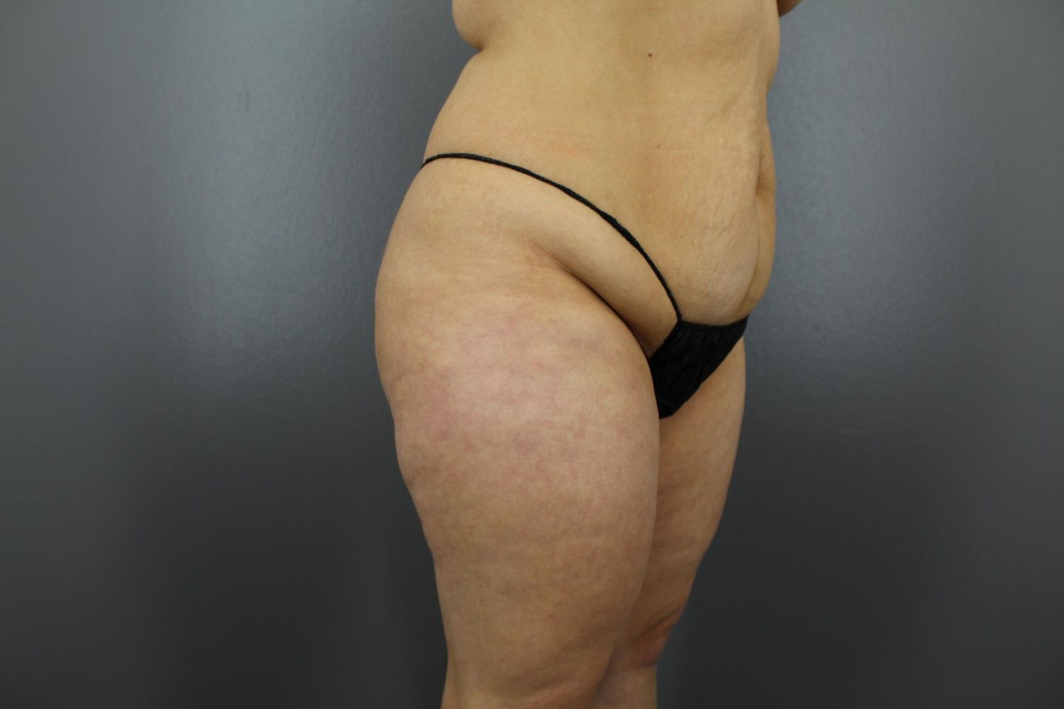 Liposuction Before & After