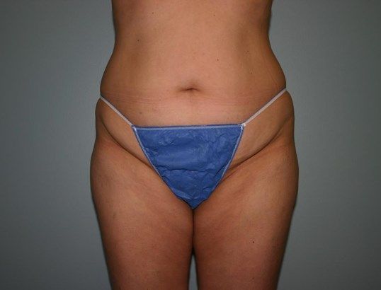 Liposuction Before & After