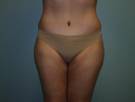 Liposuction Before & After