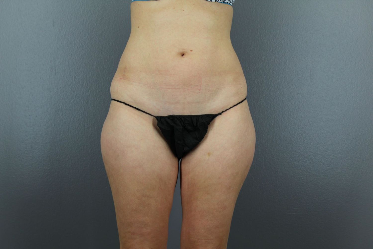Liposuction Before & After