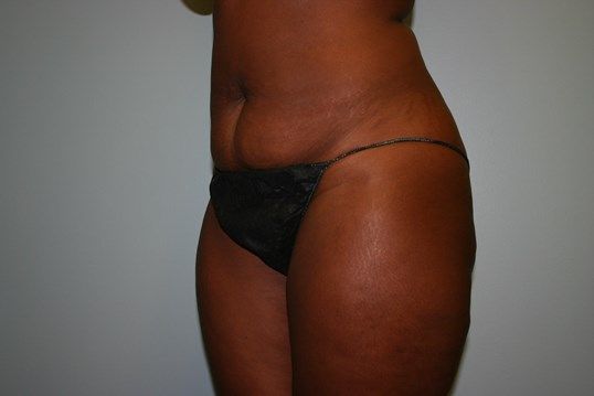 Liposuction Before & After