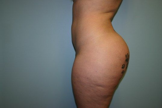 Liposuction Before & After
