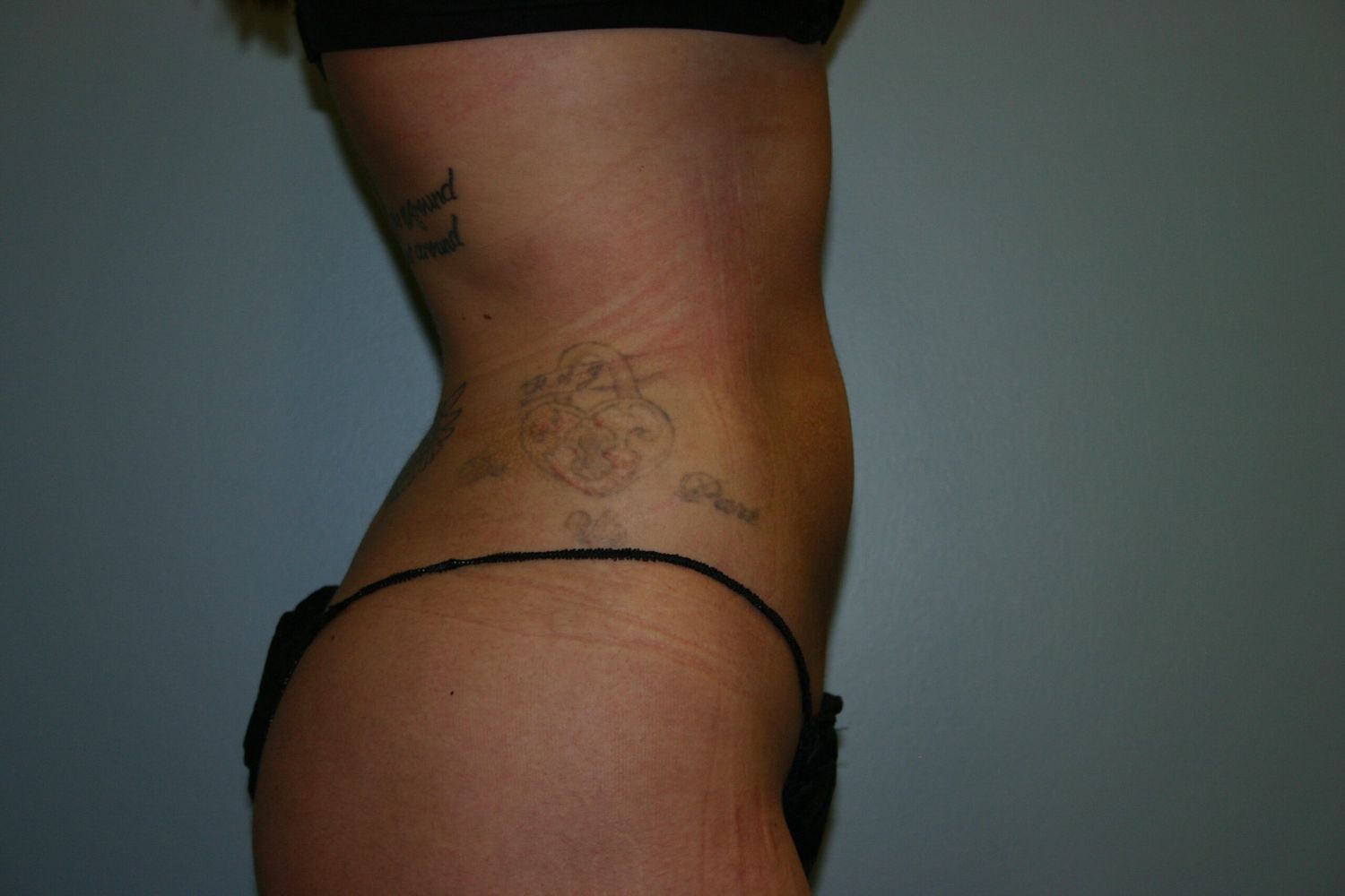 Liposuction Before & After