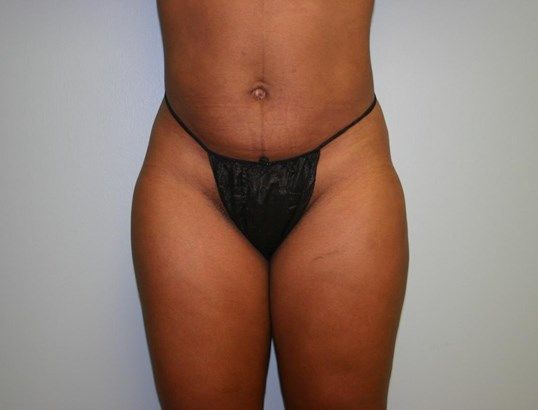 Liposuction Before & After