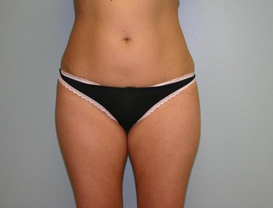 Liposuction Before & After