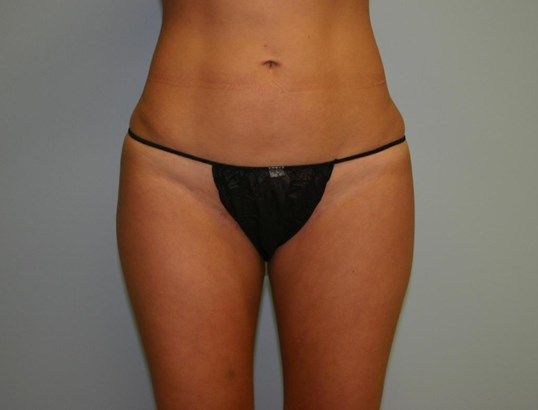 Liposuction Before & After