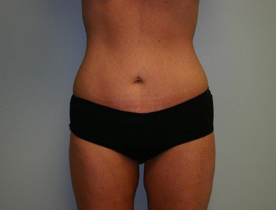 Liposuction Before & After