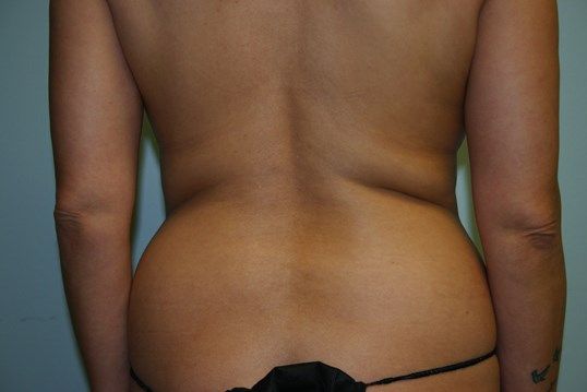 Liposuction Before & After