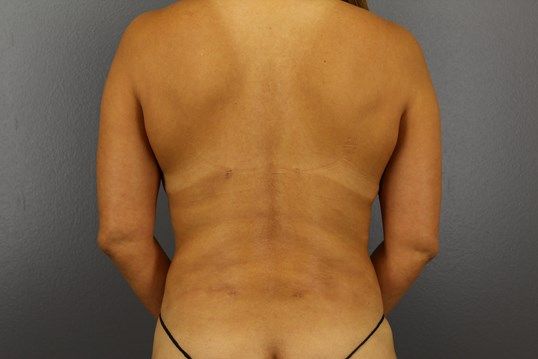 Liposuction Before & After
