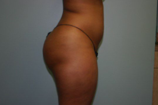 Liposuction Before & After