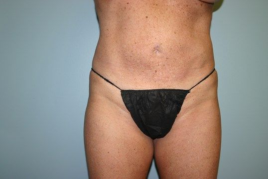 Liposuction Before & After
