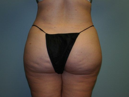 Liposuction Before & After