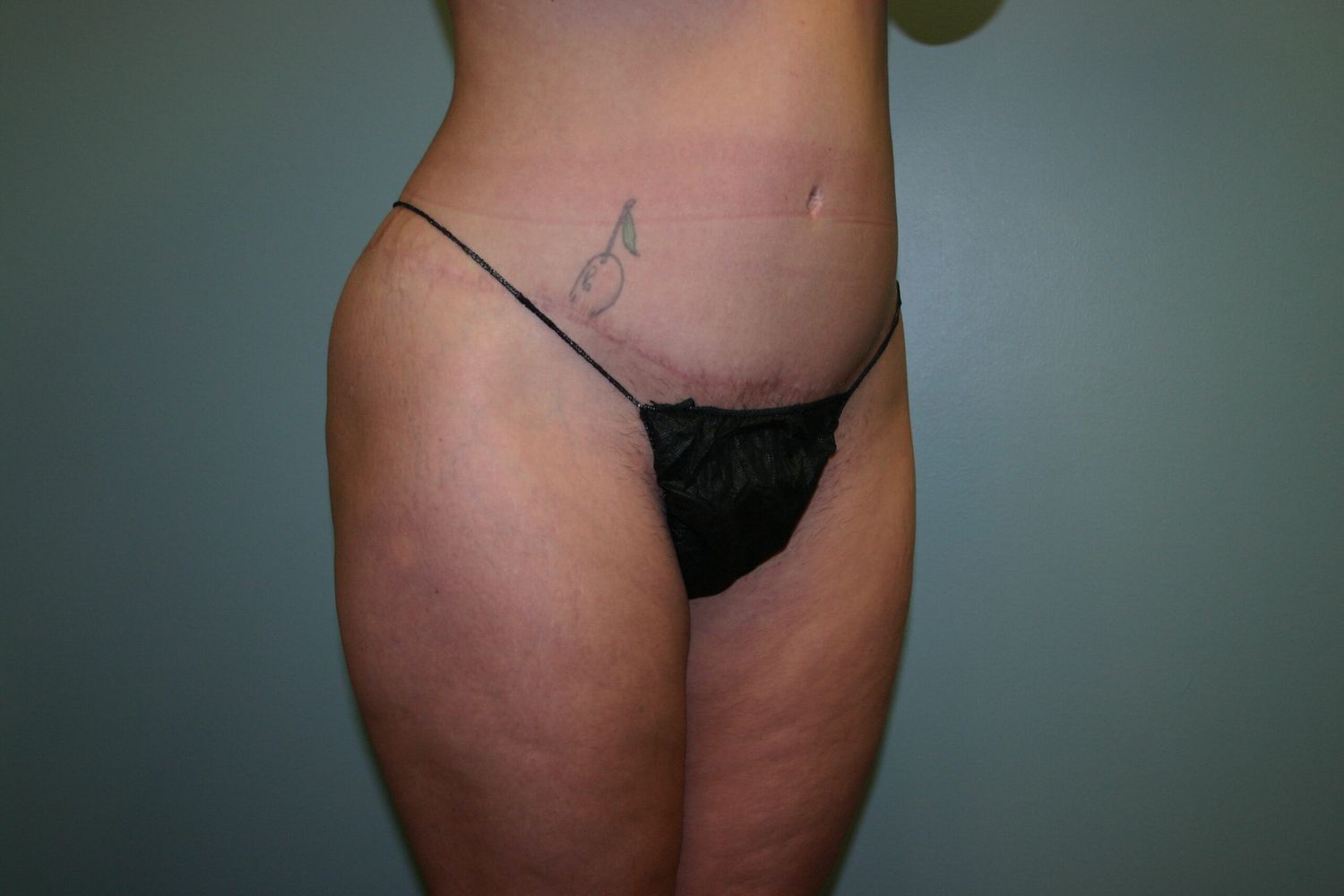 Liposuction Before & After