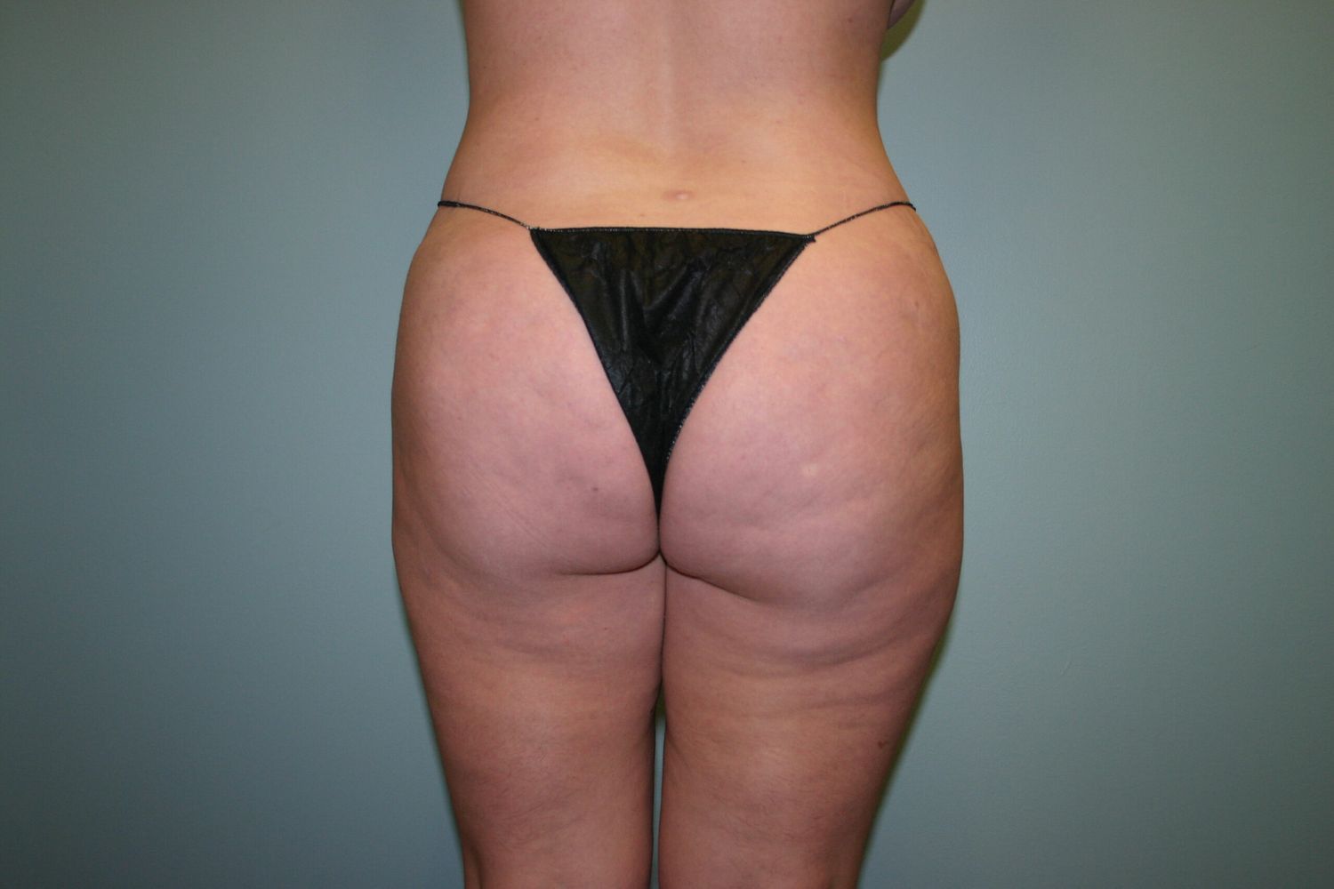 Liposuction Before & After