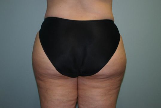 Liposuction Before & After
