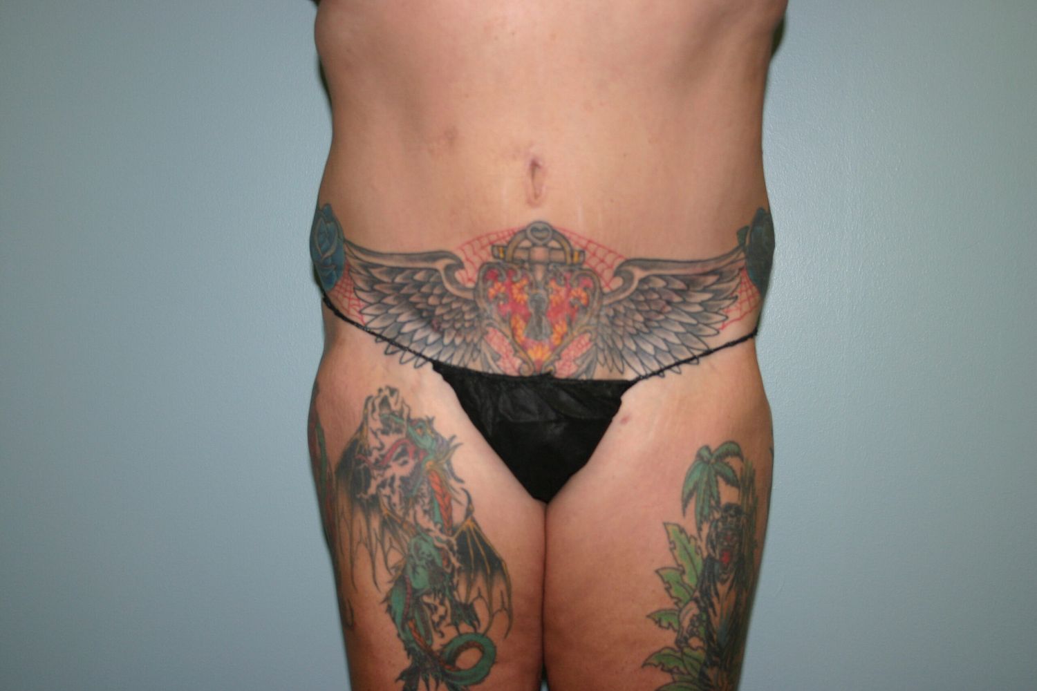 Liposuction Before & After