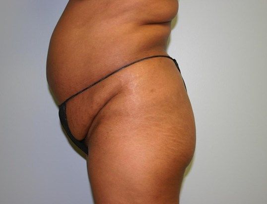Liposuction Before & After