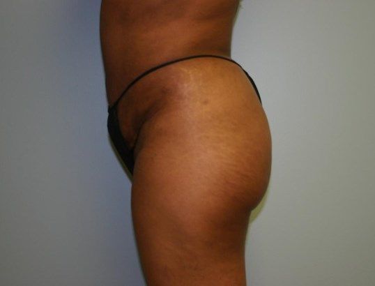 Liposuction Before & After