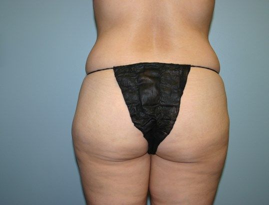 Liposuction Before & After