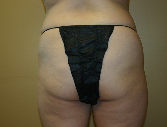 Liposuction Before & After
