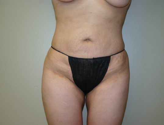 Liposuction Before & After