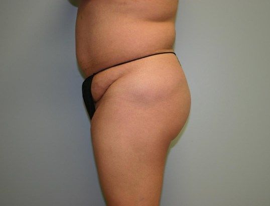 Liposuction Before & After