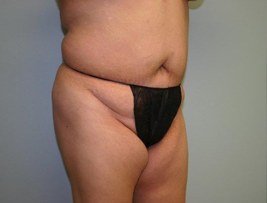 Liposuction Before & After