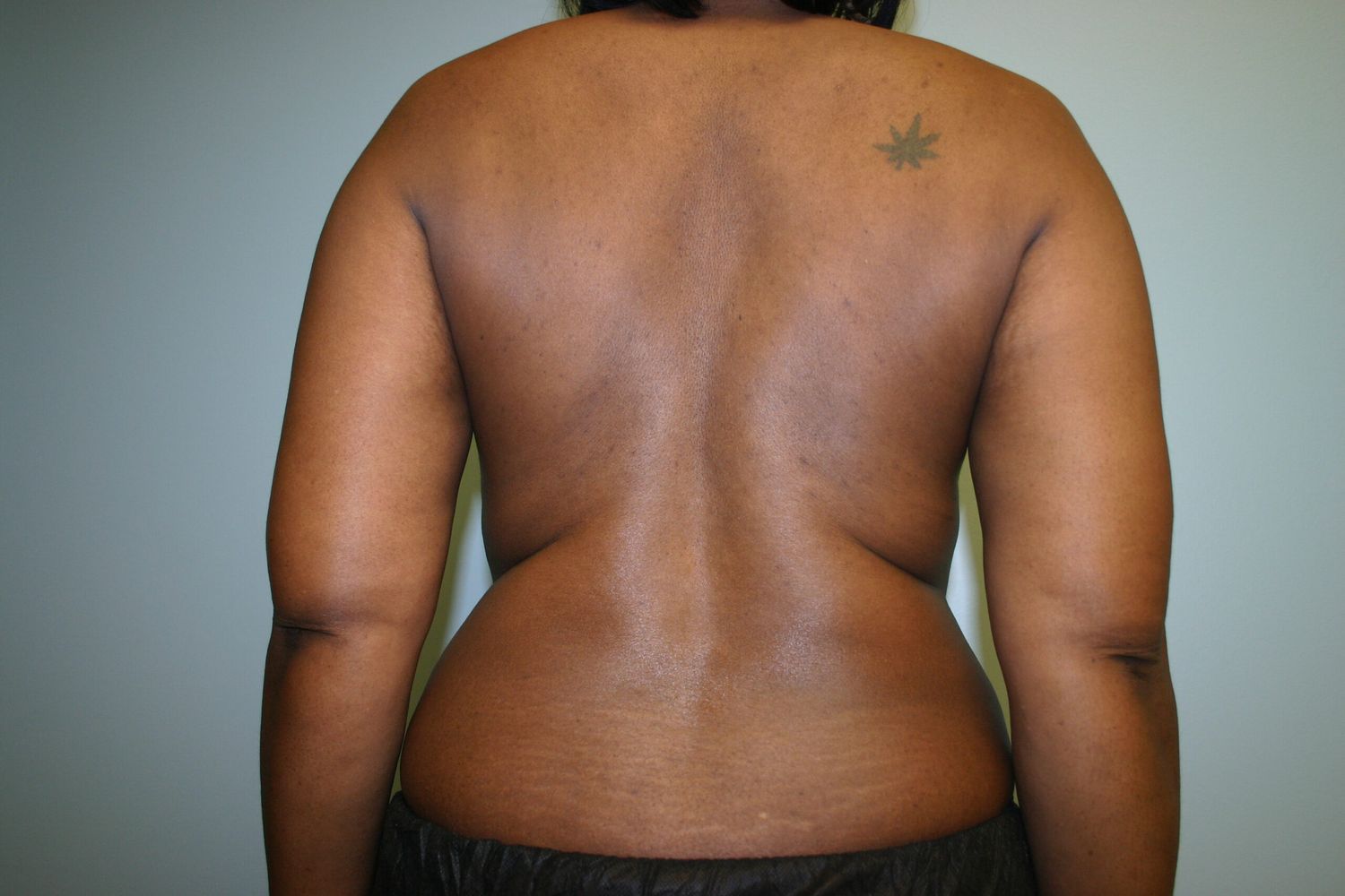 Liposuction Before & After