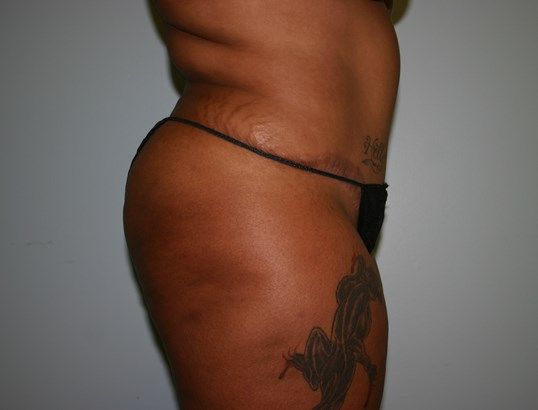 Liposuction Before & After