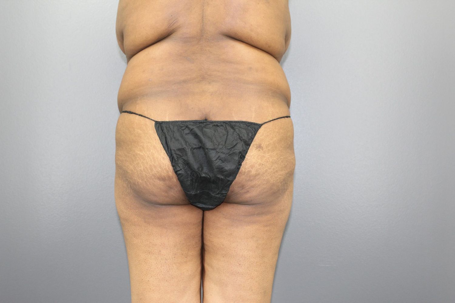 Liposuction Before & After