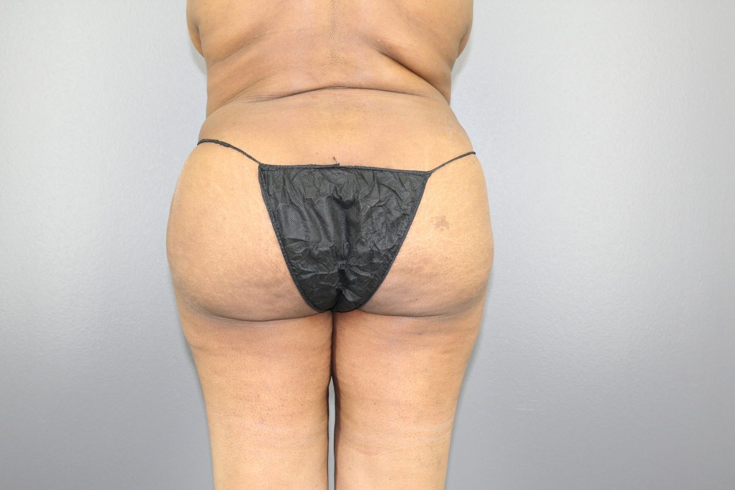 Liposuction Before & After