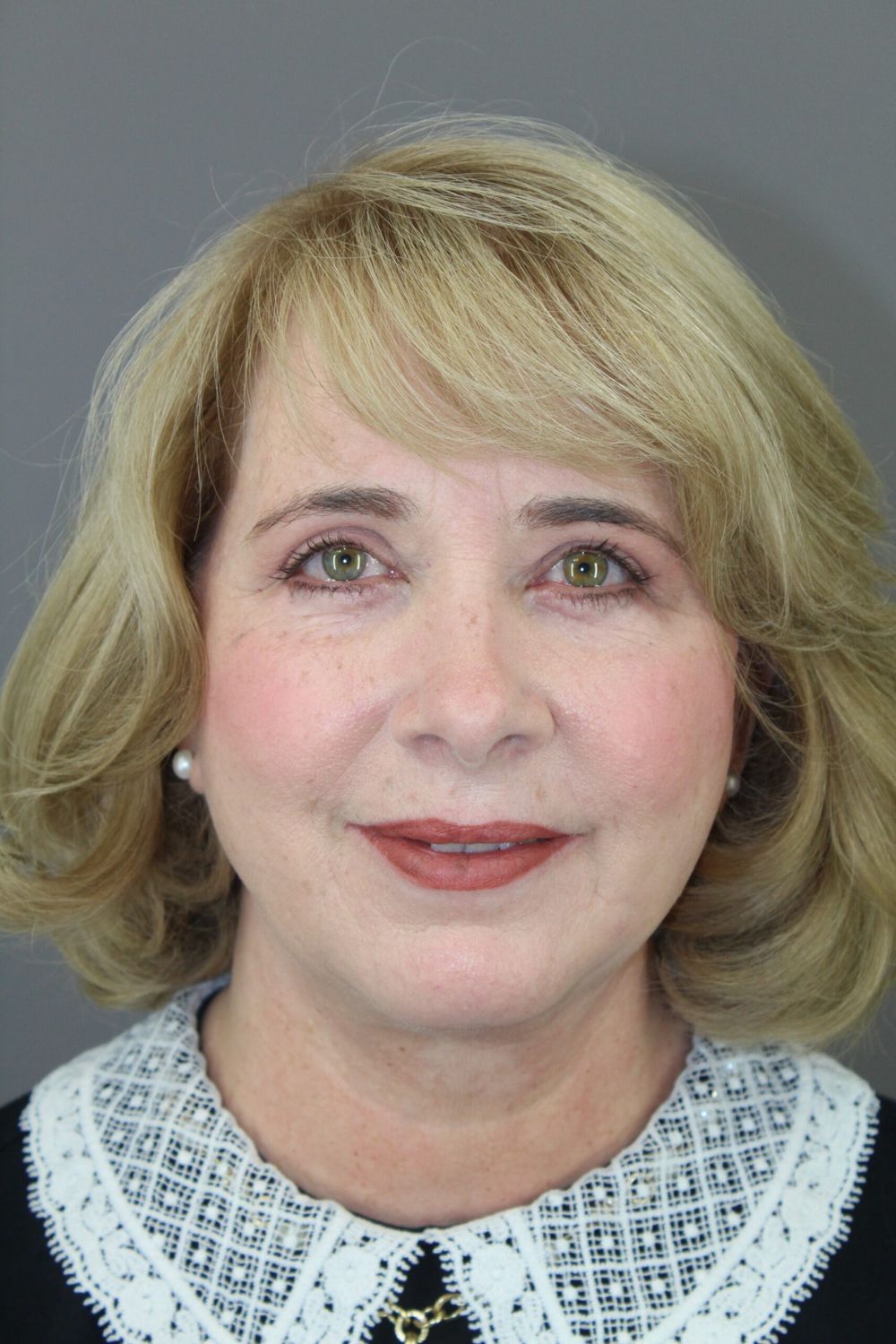 Brow Lift Before & After