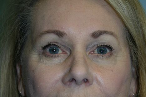 Brow Lift Before & After