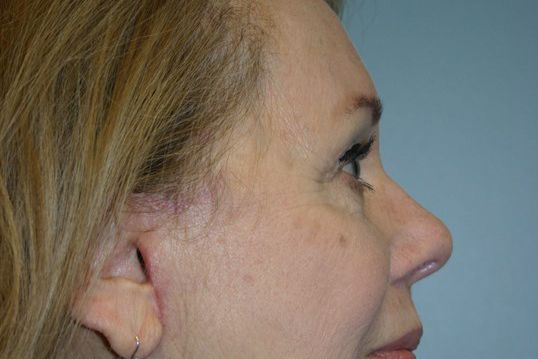 Brow Lift Before & After