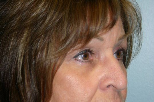 Brow Lift Before & After