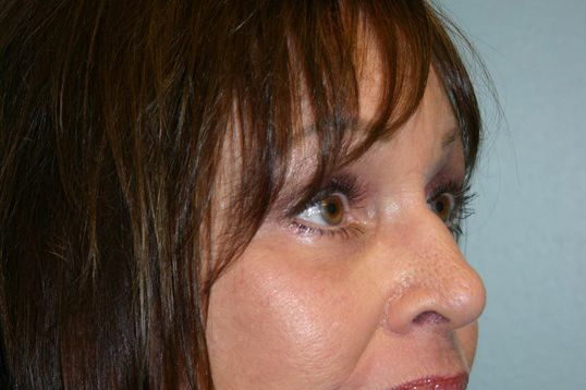 Brow Lift Before & After