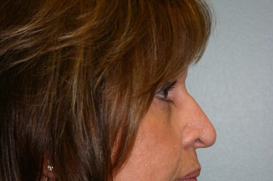 Brow Lift Before & After